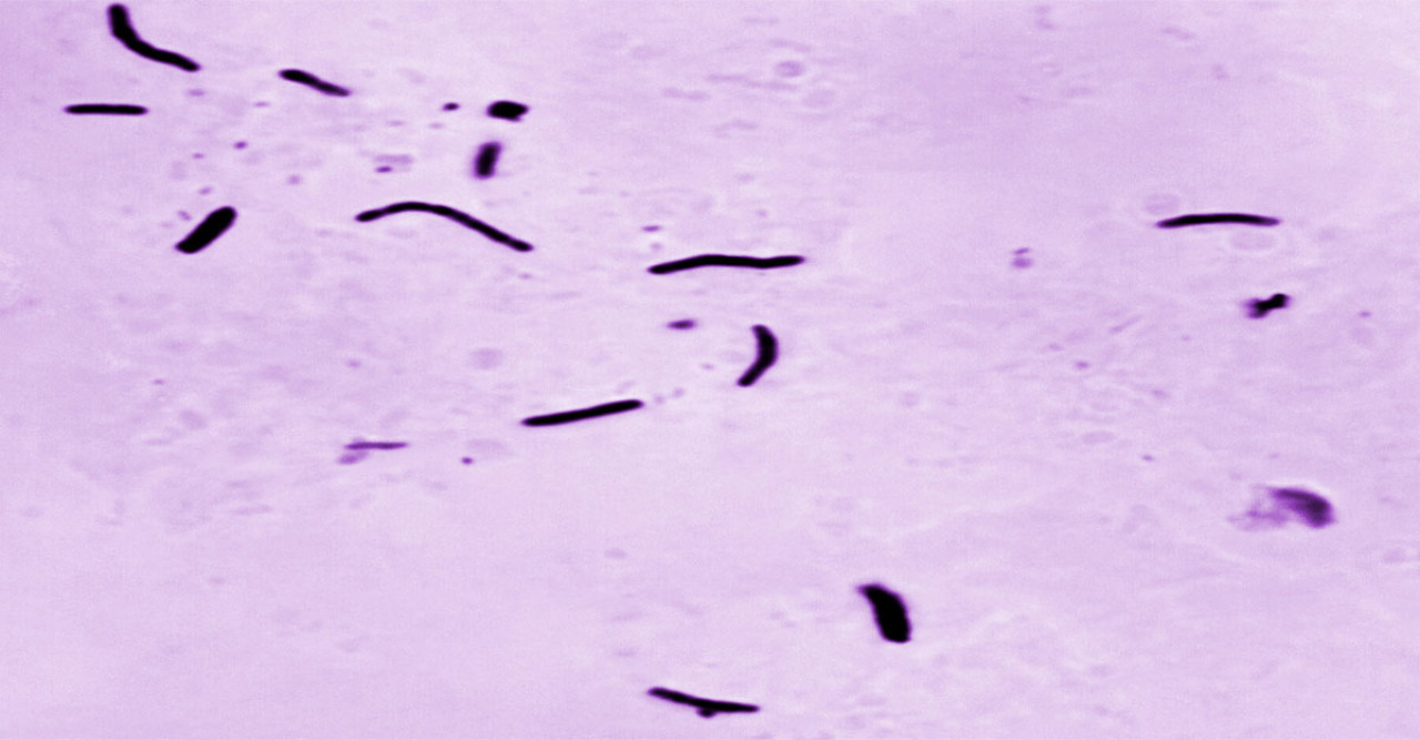 Kansas City Faces One of the Largest Tuberculosis Outbreaks in U.S. History