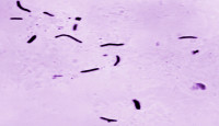 Kansas City Faces One of the Largest Tuberculosis Outbreaks in U.S. History