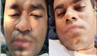 নাউরুতে মুখ সেলাই করে দুই বাংলাদেশির প্রতিবাদ