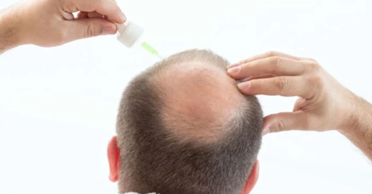মাত্র ২০ দিনেই টাক মাথায় নতুন চুল! বিপ্লবী সিরাম উদ্ভাবন করলেন বিজ্ঞানীরা