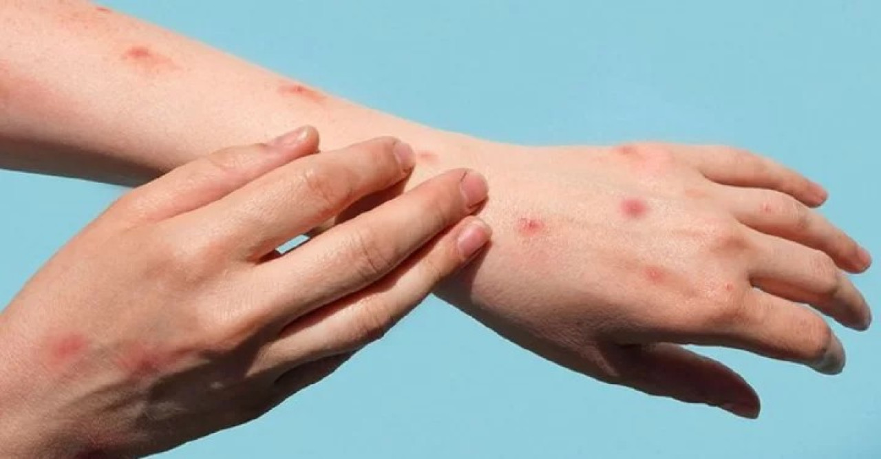 এমপক্সের ‘ভয়ঙ্কর’ ধরণ শনাক্ত ভারতে 