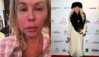 Brandi Glanville Reveals Benign Tumor Discovery After Years of Facial Health Struggles and Medical Dismissals